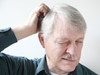 Scalp Psoriasis Symptoms