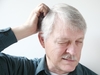 Scalp Psoriasis Symptoms Scalp Psoriasis Symptoms